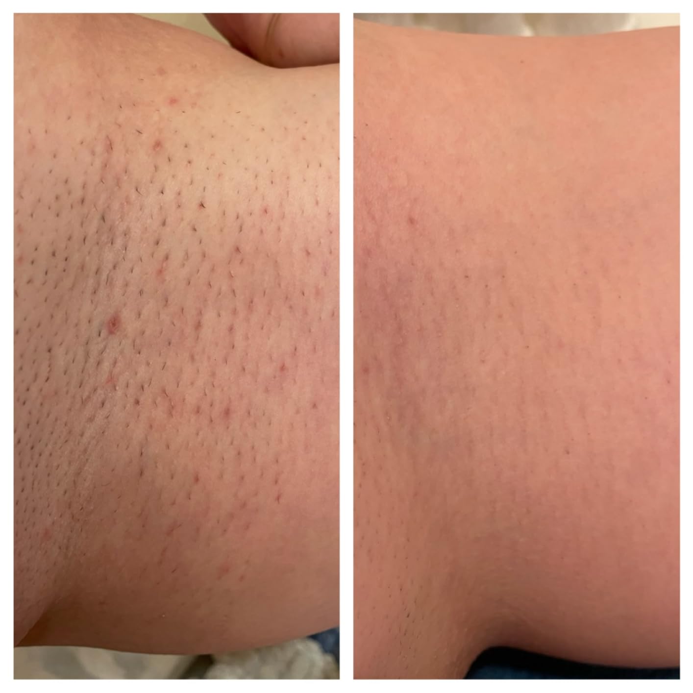 Braun IPL, Silk·Expert Pro 5, IPL Hair Removal for Women and Men, Permanent Laser Hair Reduction At-Home, 2 Heads, Pouch, IPL5137 customer photo 1
