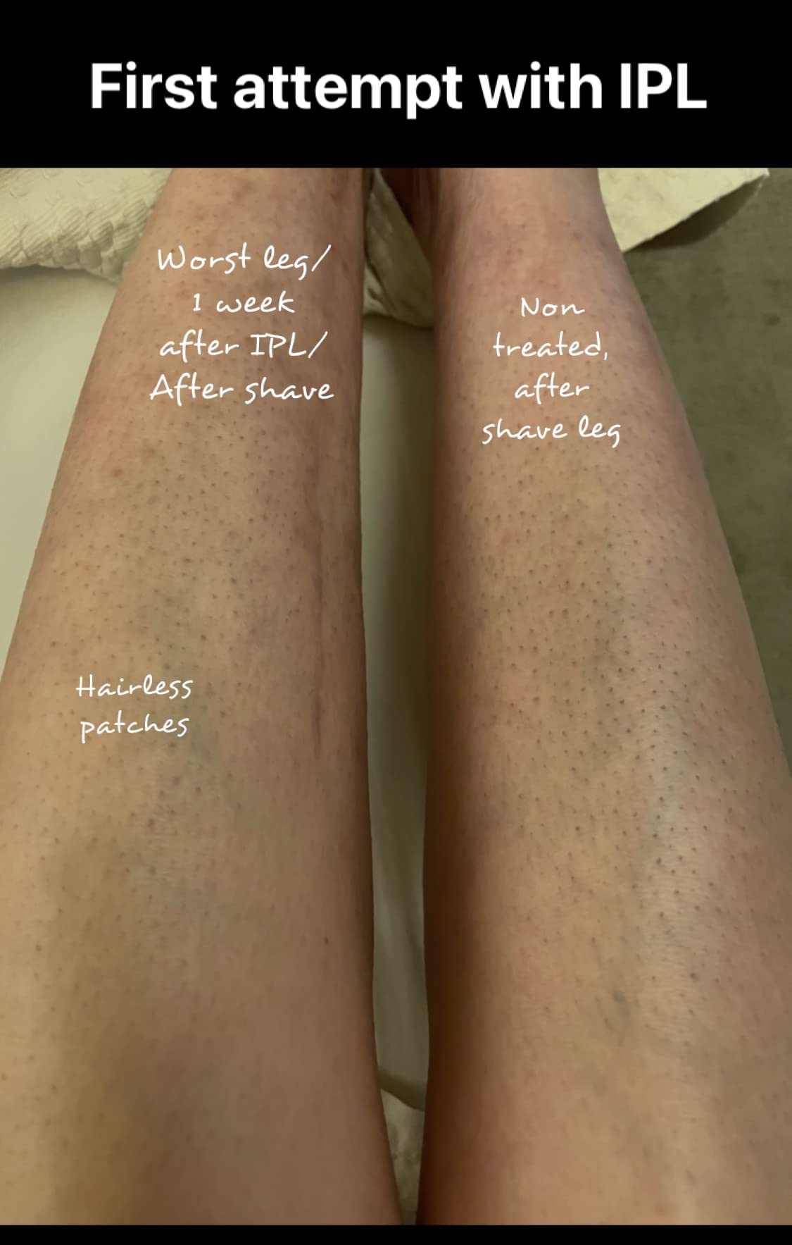Braun IPL, Silk·Expert Pro 5, IPL Hair Removal for Women and Men, Permanent Laser Hair Reduction At-Home, 2 Heads, Pouch, Venus Razor, IPL5157 customer photo 2